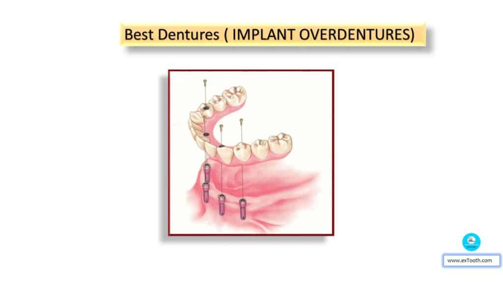 best dentures