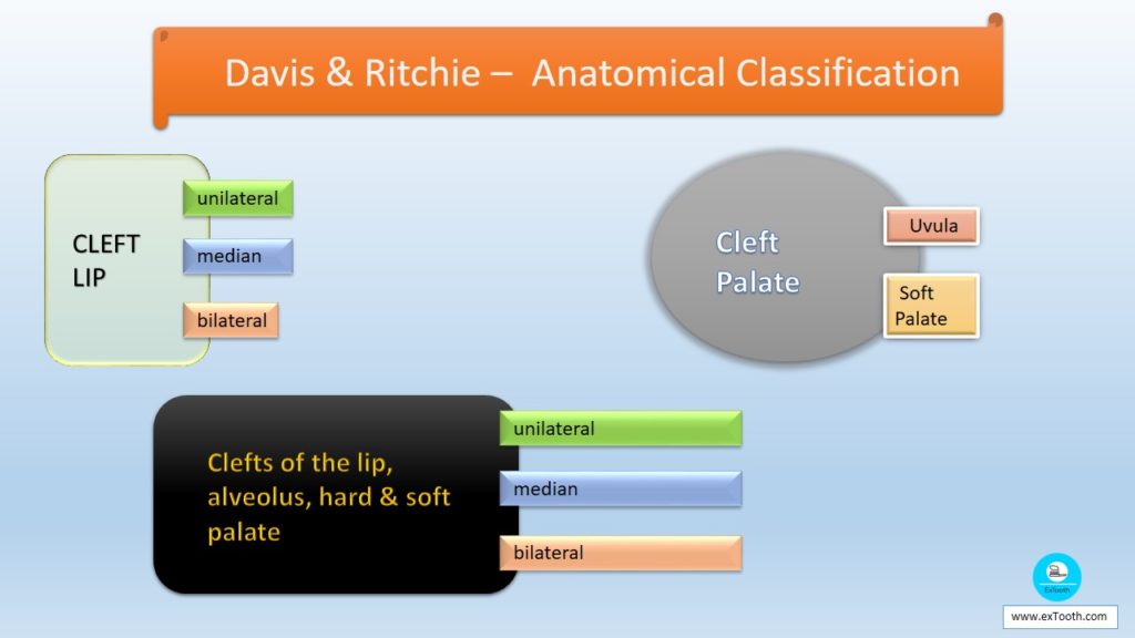 Davis & Ritchie –  Anatomical Classification of of Cleft lip and palate