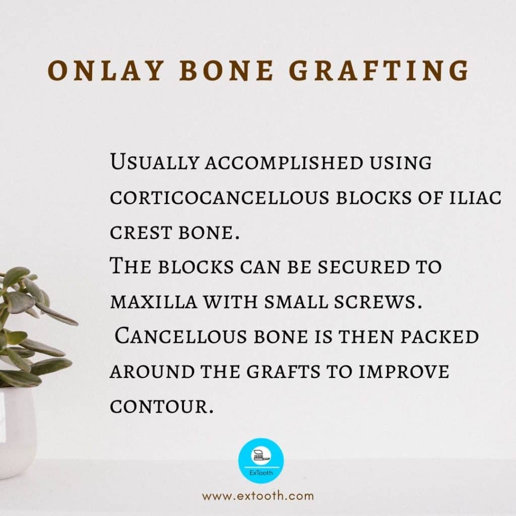 ONLAY BONE GRAFTING