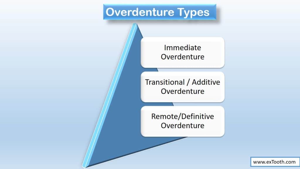 types of overdenture