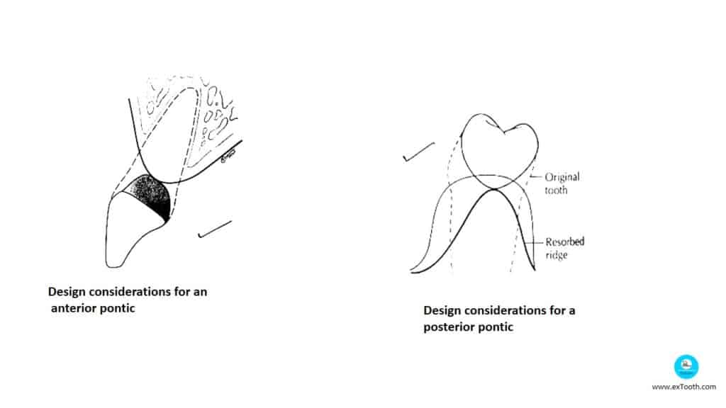 Design considerations for a posterior pontic 