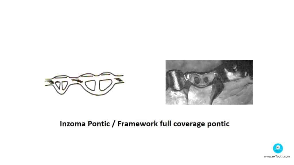 Inzoma Pontic/Framework full coverage pontic