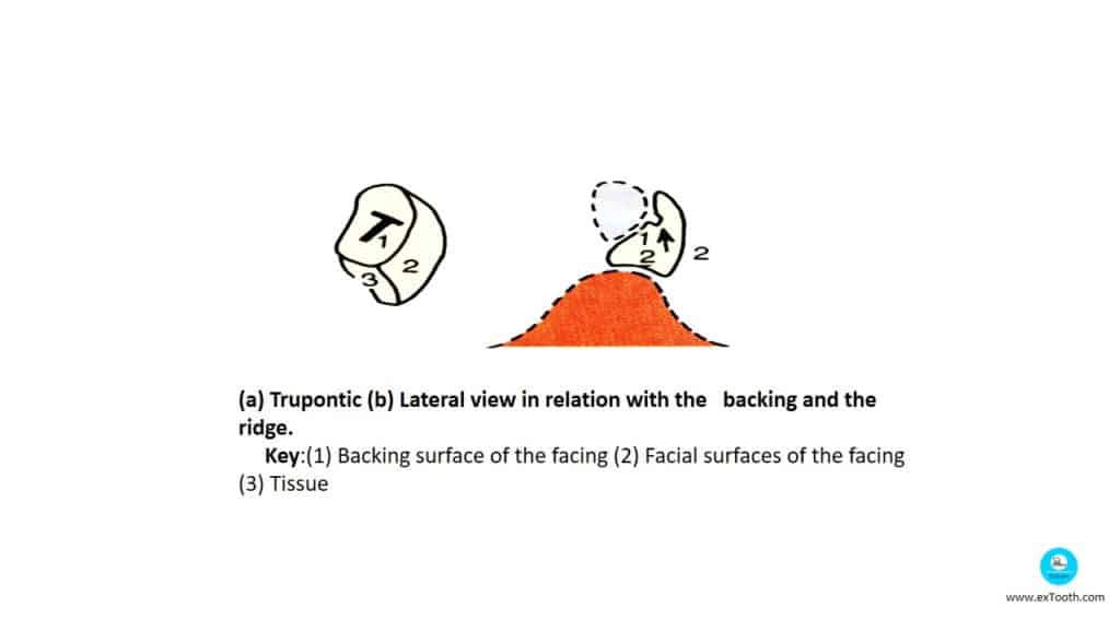 (a) Trupontic (b) Lateral view in relation with the   backing and the ridge.
     Key:(1) Backing surface of the facing (2) Facial surfaces of the facing  (3) Tissue 