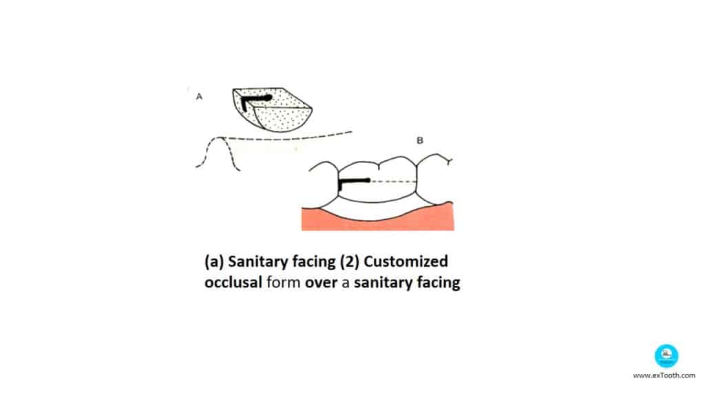 (a) Sanitary facing (2) Customized
occlusal form over a sanitary facing

