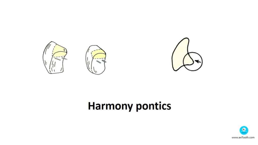Harmony pontics