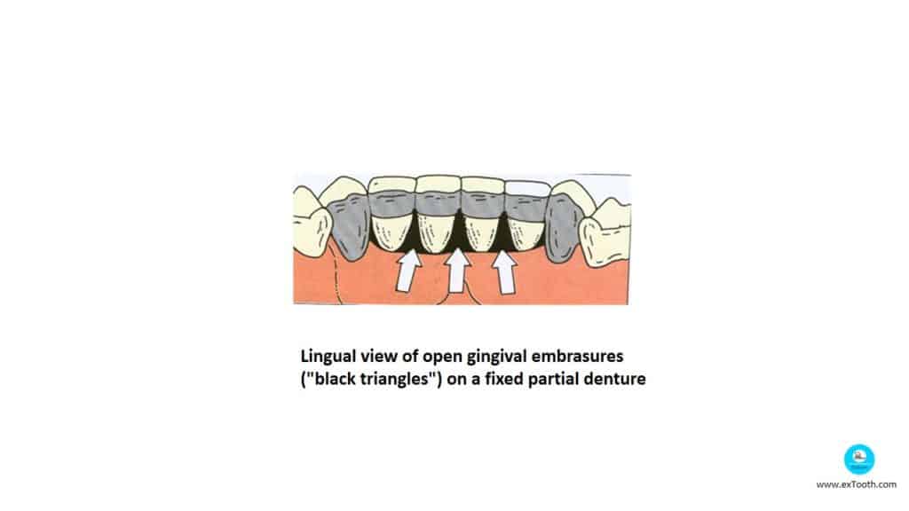 Lingual view of open gingival embrasures
("black triangles") on a fixed partial denture
