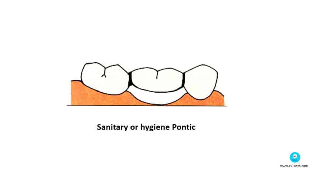 Sanitary or hygiene Pontic