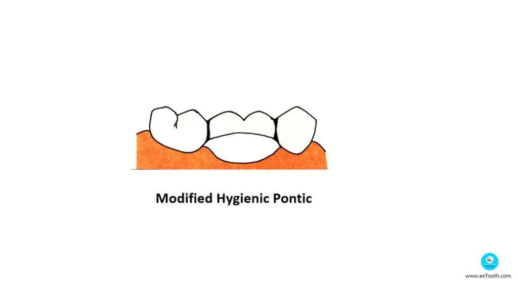 Modified Hygienic Pontic