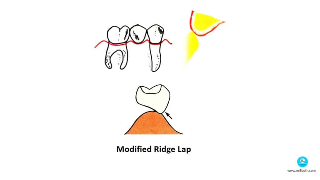 Modified Ridge Lap