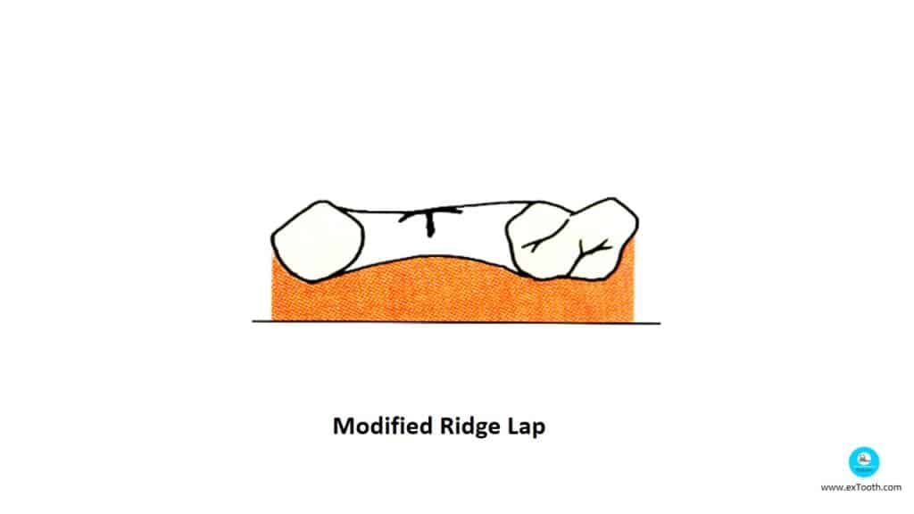Modified Ridge Lap
