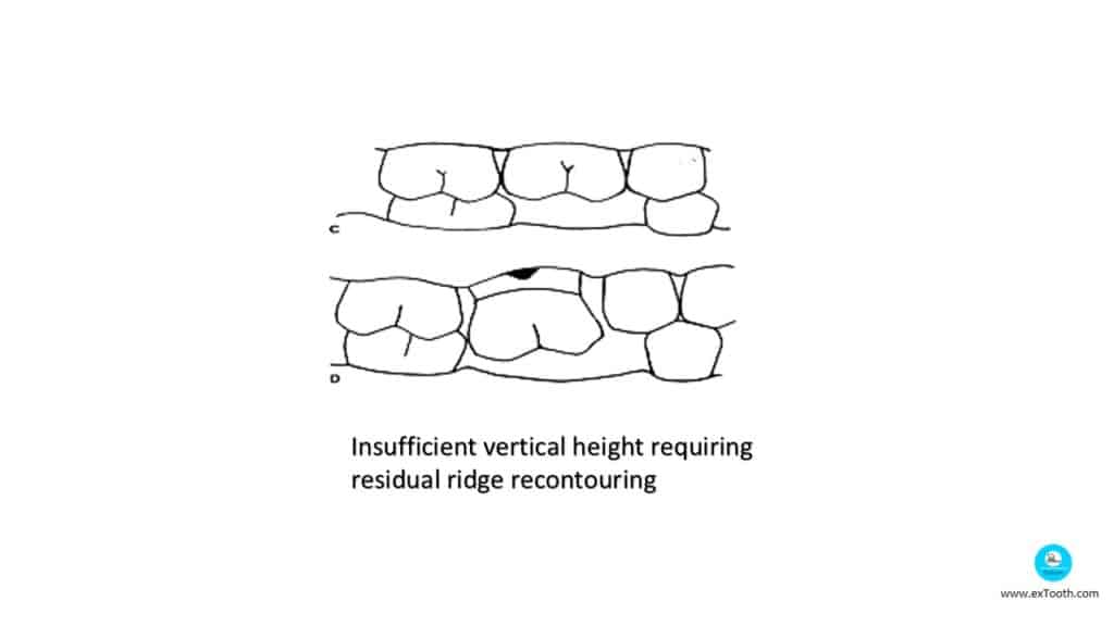 Insufficient vertical height requiring residual ridge reconturing