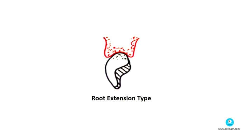 Root Extension Type