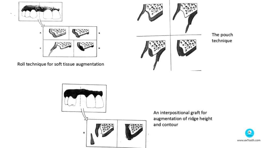 An interpositional graft for augmentation of ridge height and contour
