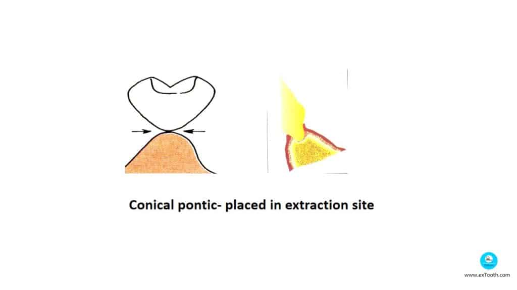 
Conical pontic- placed in extraction site
