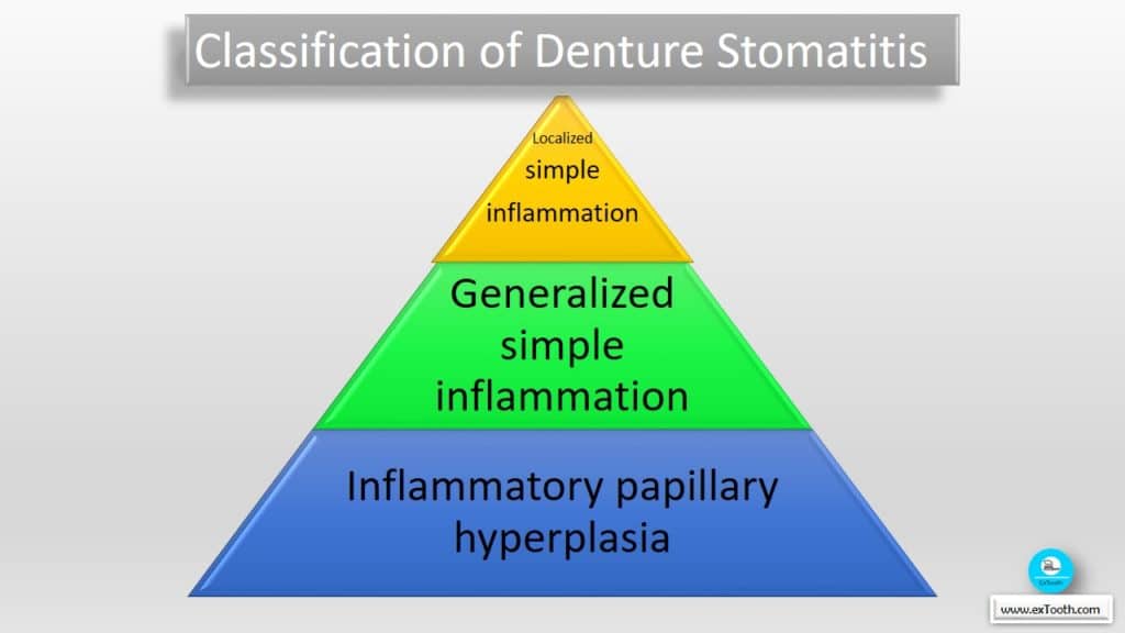 Classification of Denture Stomatitis