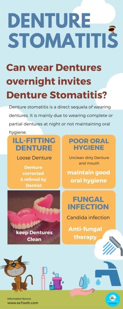 denture stomatitis