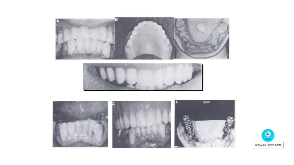 Single Complete Denture 