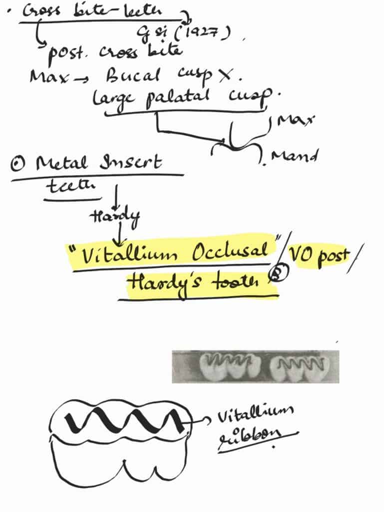 vitallium teeth in complete denture