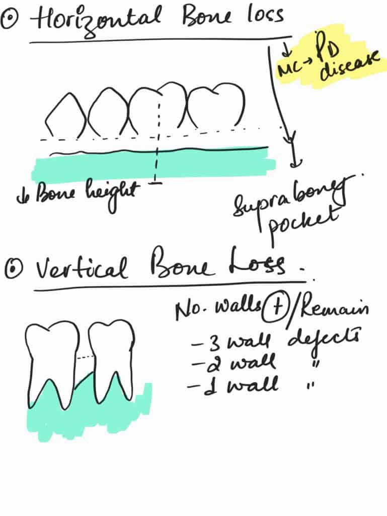 horizontal bone loss